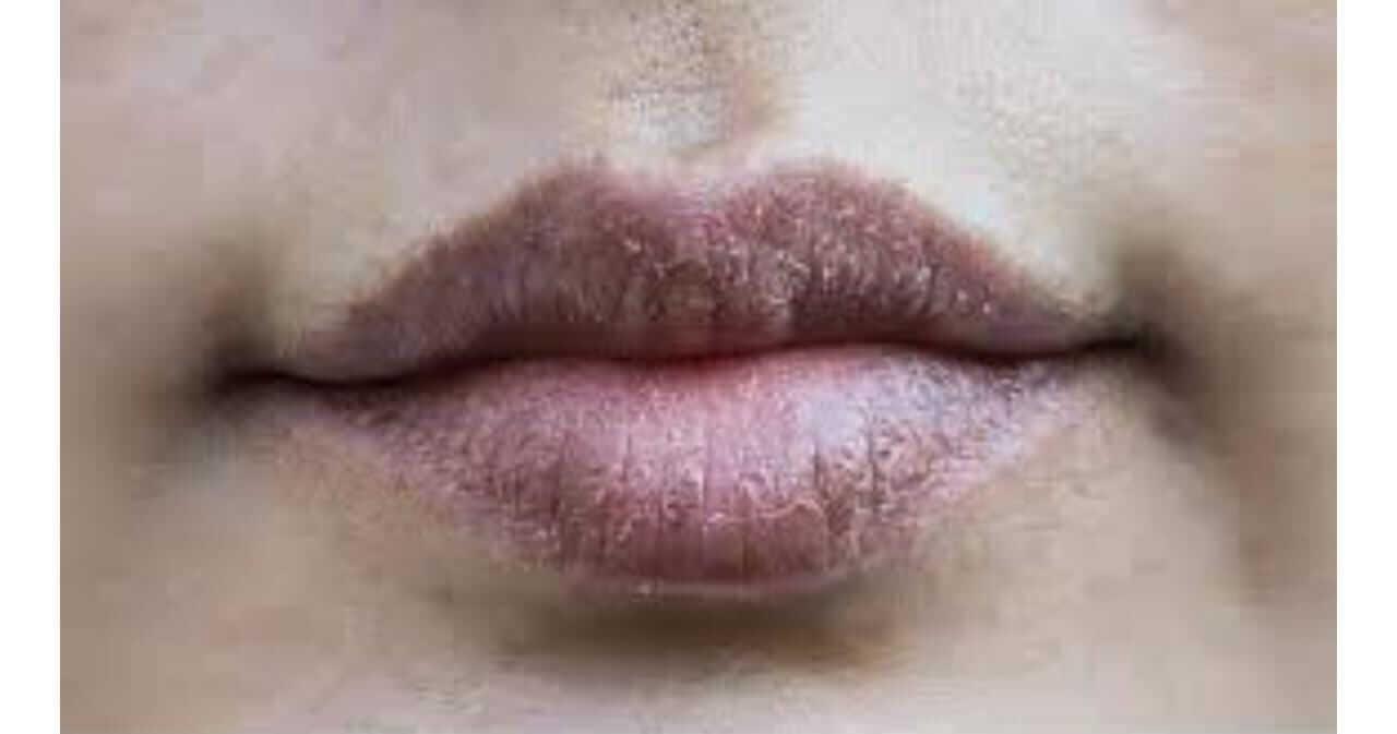 ओठांभोवतीचा काळेपणा घालवण्यासाठी करा ‘हे’ घरगुती उपाय
