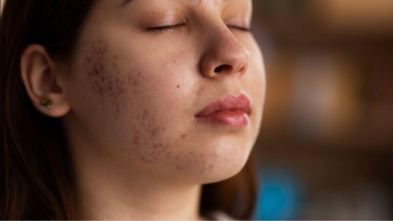 Skin Care: पिंपल्समुळे चेहऱ्यावर काळे डाग पडलेत? ‘या’ घरगुती उपायाने मिळेल नितळ त्वचा