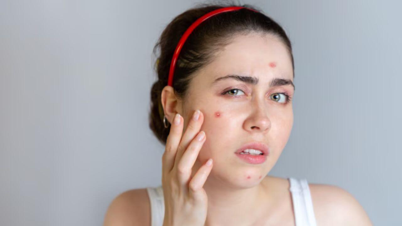 Pimple Remedies:  पिंपल्सची समस्या दूर करायची आहे? मग फॉलो करा ‘या’ ६ टिप्स