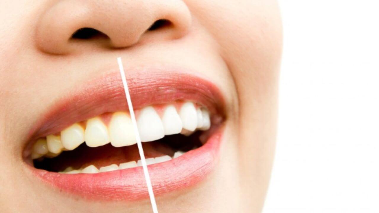 दातांवर पिवळा-काळा थर साचून दुर्गंधी येतेय? ‘हे’ घरगुती उपाय पांढरेशुभ्र बनवतील दात