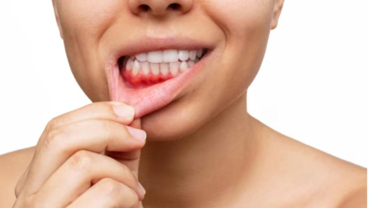 तुमच्याही हिरड्यांमधून रक्त येते का? ‘हे’ घरगुती उपाय दूर करतील समस्या