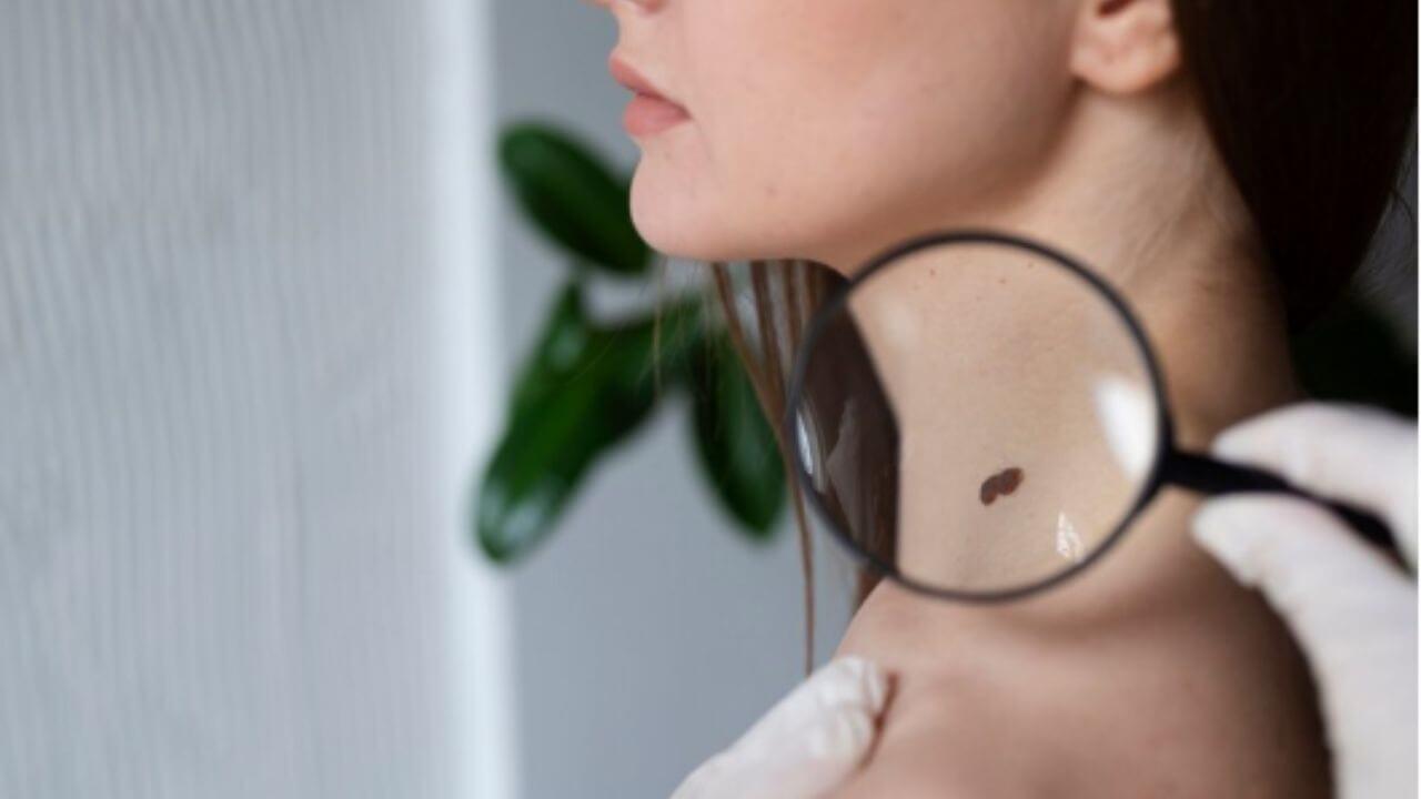 चेहऱ्यावर-मानेवर चामखीळ आल्याने त्रस्त आहात? ‘हे’ घरगुती उपाय दूर करतील समस्या