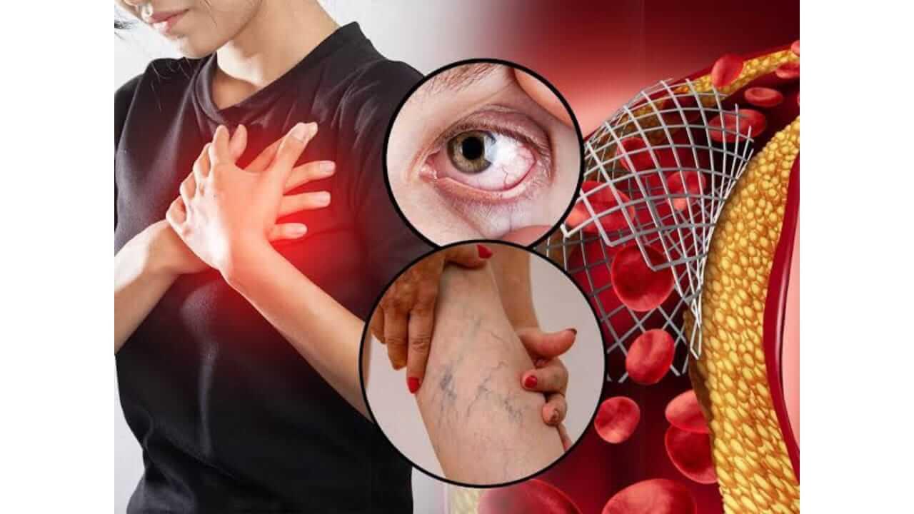 कोलेस्ट्रॉल शरीरात कशामुळे वाढतं? जाणून घ्या लक्षणं