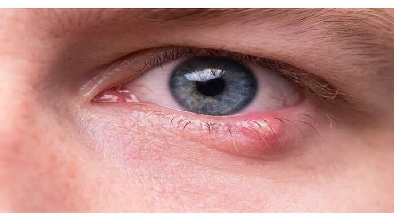 रांजणवाडी का होते? जाणून घ्या कारणे, लक्षणे आणि उपाय…