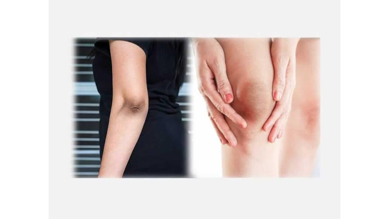 गुडघ्यांचा काळपटपणा घालवण्यासाठी ‘हे’ खास घरगुती उपाय नक्की करा!