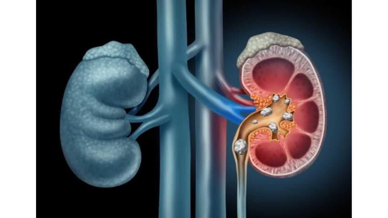 जर तुम्हाला किडनी स्टोन असेल तर ‘हे’ रामबाण घरगुती उपाय करून पाहाच