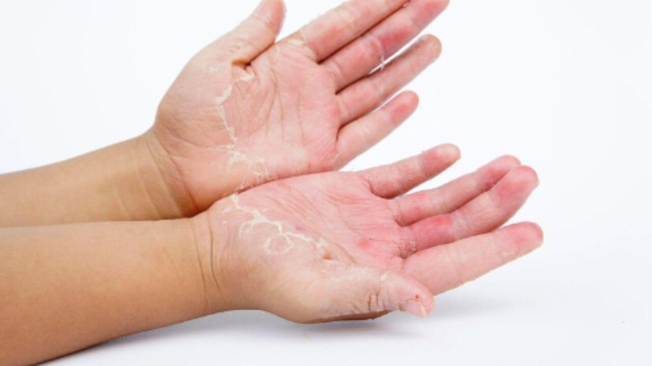 पावसाळ्यात हातांना फंगल इन्फेक्शन झालंय? करा ‘हे’ घरगुती उपाय