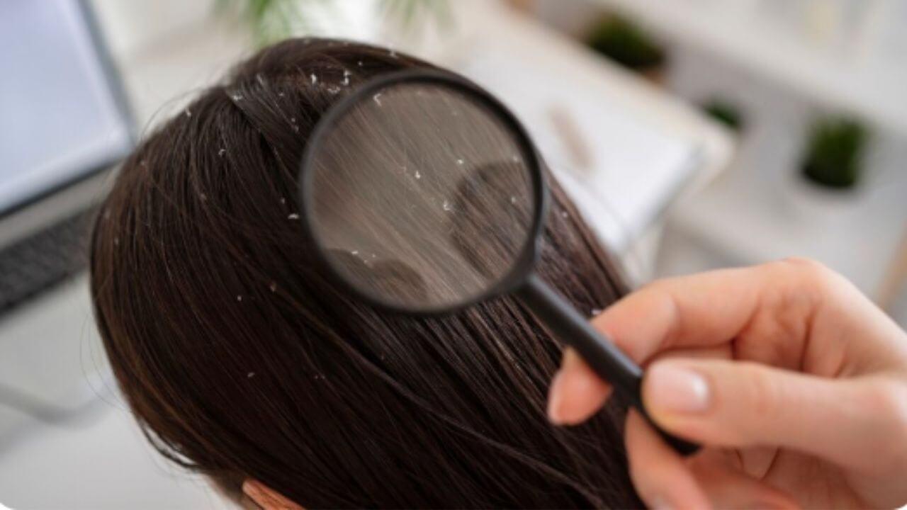 पावसाळ्यात केसांमध्ये प्रचंड कोंडा झालाय? ‘हे’ सोपे उपाय दूर करतील समस्या