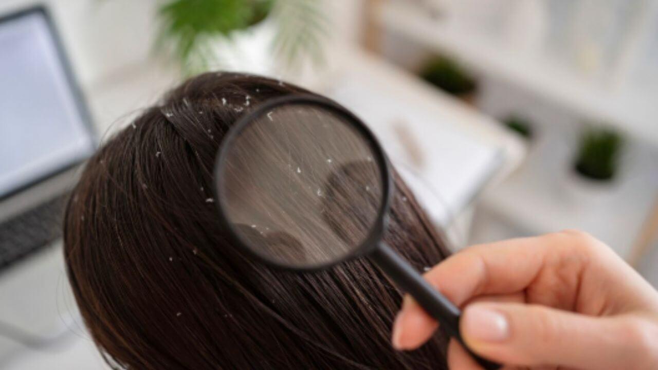 केसांमध्ये कोंडा झालाय, खाजही सुटतेय? ‘हे’ आयुर्वेदिक उपाय दूर करतील समस्या