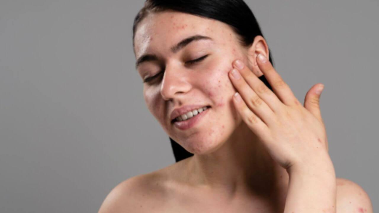 पिंपल्स फुटून चेहऱ्यावर खड्डे आणि डाग पडलेत? ‘हे’ घरगुती उपाय नितळ बनवतील त्वचा