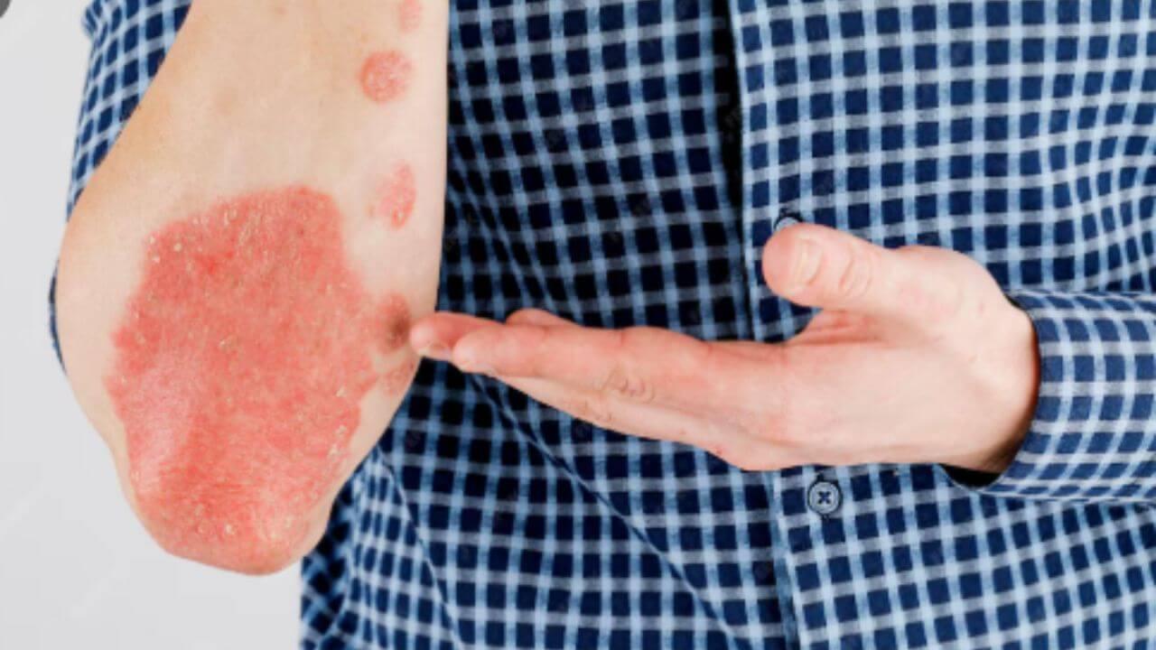 फंगल इन्फेक्शनमुळे त्वचेला खाज सुटून त्वचेची आग होतेय? ‘हे’ घरगुती उपाय देतील आराम