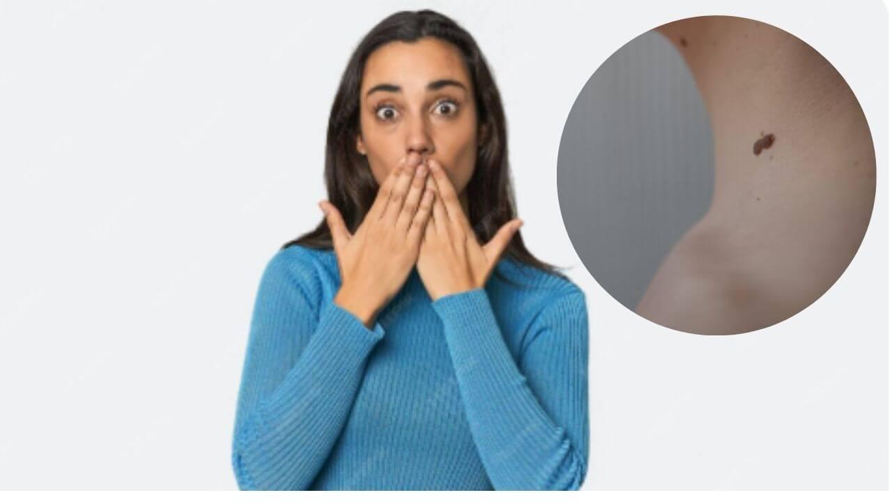 शरीरावर सर्वत्र चामखिळी आल्याने त्रस्त आहात? ‘हे’ आयुर्वेदिक उपाय दूर करतील समस्या