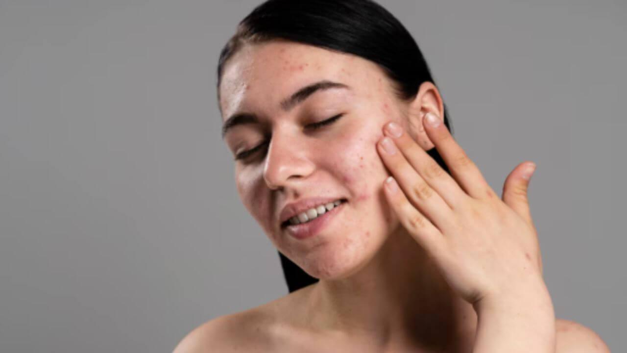 चेहेऱ्यावर सतत पिंपल्स येऊ नयेत म्हणून काय करावे? ‘या’ सोप्या टिप्स फॉलो करा