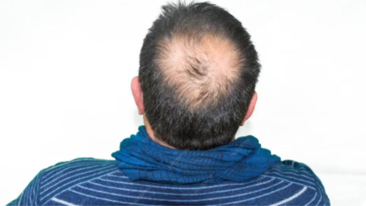 पुरुषांनी केस गळतीसाठी काय करावे? ‘हे’ आहेत सोपे आयुर्वेदिक उपाय