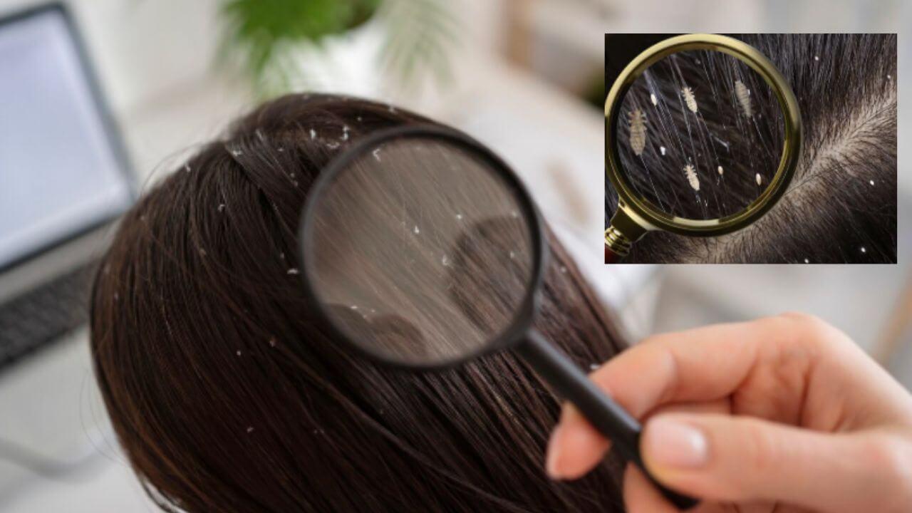 तुमच्याही केसांमध्ये उवा आणि लिखांची समस्या आहे? ‘हे’ घरगुती उपाय लगेच करतील दूर