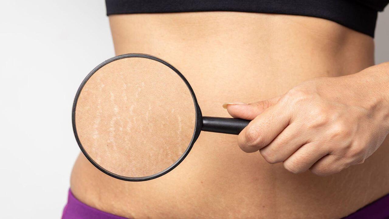 शरीरावरील स्ट्रेच मार्क्समुळे आवडते कपडे घालणे कठीण होतंय? ‘हे’  घरगुती उपाय एकसारखी नितळ बनवतील त्वचा