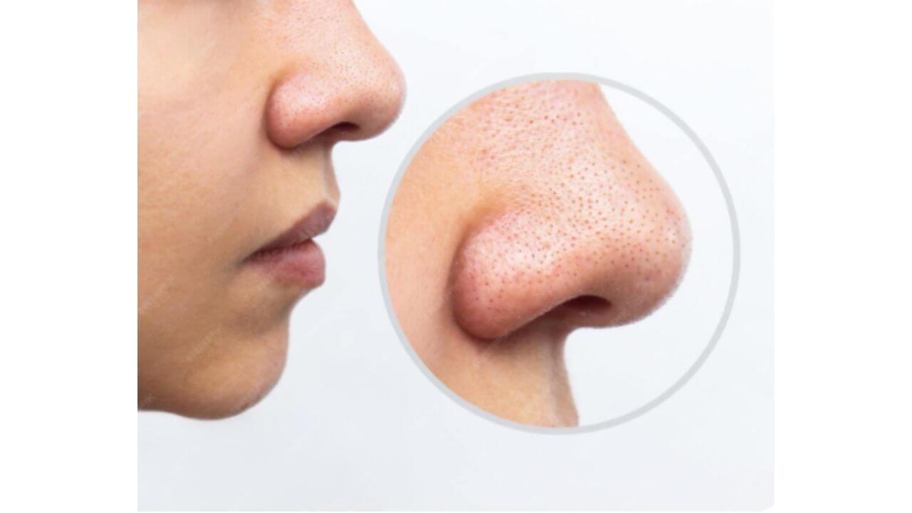 चेहऱ्यावर ओपन पोर्स वाढल्याने त्रस्त आहात? ‘हे’ घरगुती फेस पॅक देतील सुंदर गुळगुळीत त्वचा