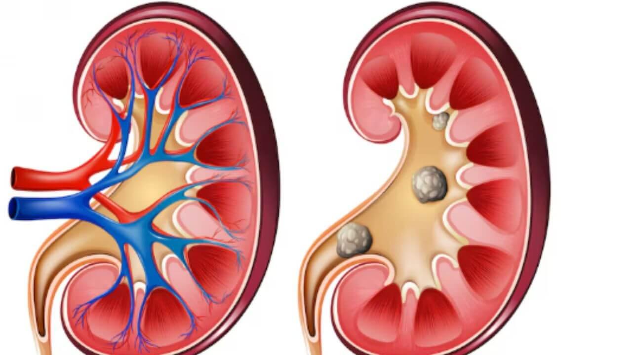 मुतखडा विरघळून लघवीद्वारे बाहेर पडेल, फक्त करा ‘हे’ आयुर्वेदिक उपाय