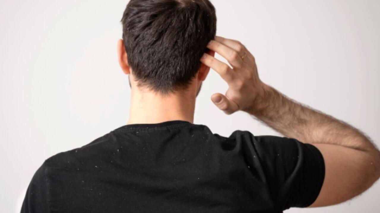 हिवाळ्यात केस निस्तेज होऊन डोक्यात कोंडा झालाय? ‘हे’ सोपे उपाय दूर करतील समस्या