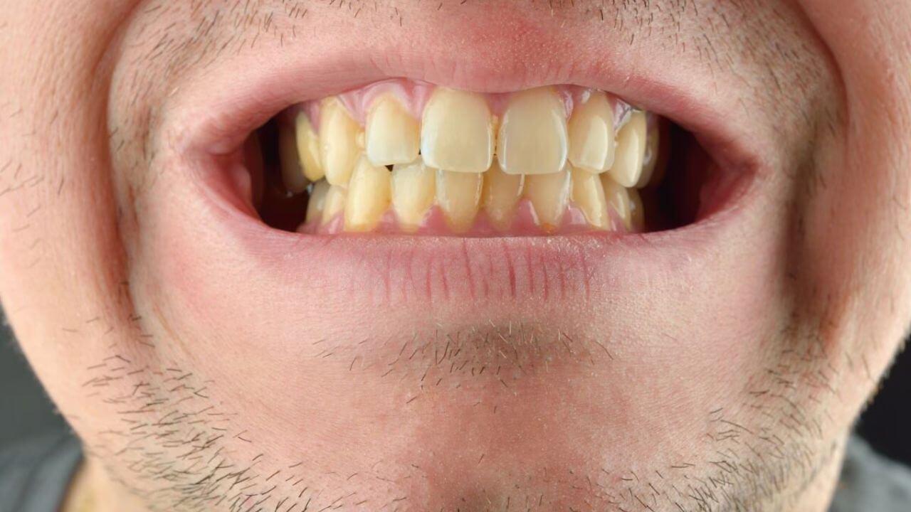 दात किडलेत, मुळ्याही कमकुवत झालेत? मजबूत आणि निरोगी दातांसाठी करा ‘हे’ घरगुती उपाय