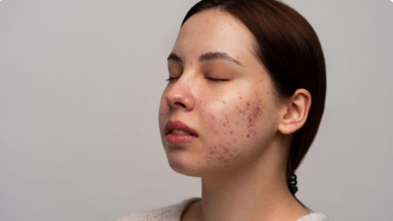पिंपल्स कमी झाले पण चेहऱ्यावर डाग पडलेत? मग ट्राय करा ‘हे’ घरगुती उपाय