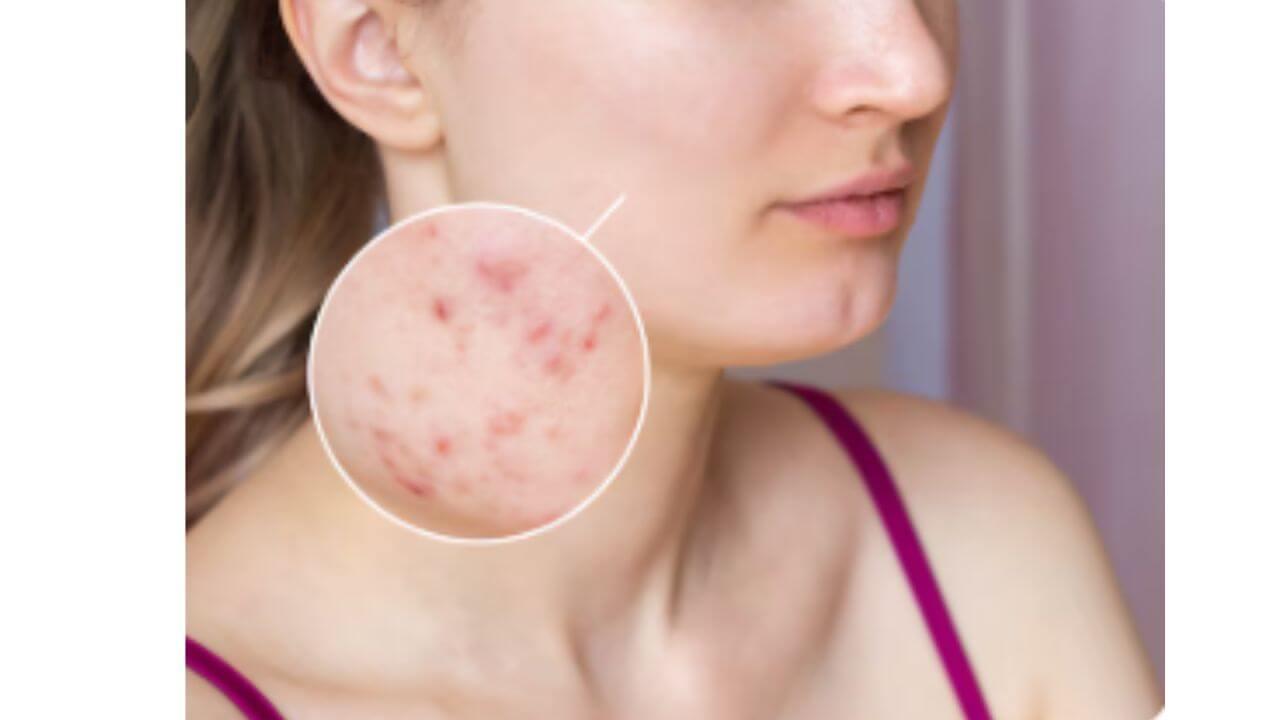 आठवड्याभरात पिंपल्स होतील गायब, फक्त करा ‘हे’ घरगुती उपाय