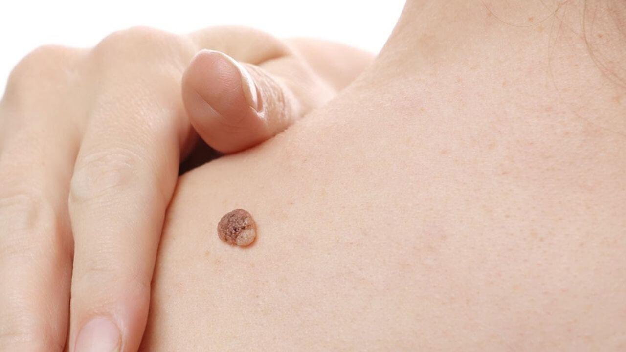 विविध उपाय करूनही चामखीळ जात नाहीय? स्वयंपाकघरातील ‘हे’ पदार्थ मुळापासून काढून टाकतील