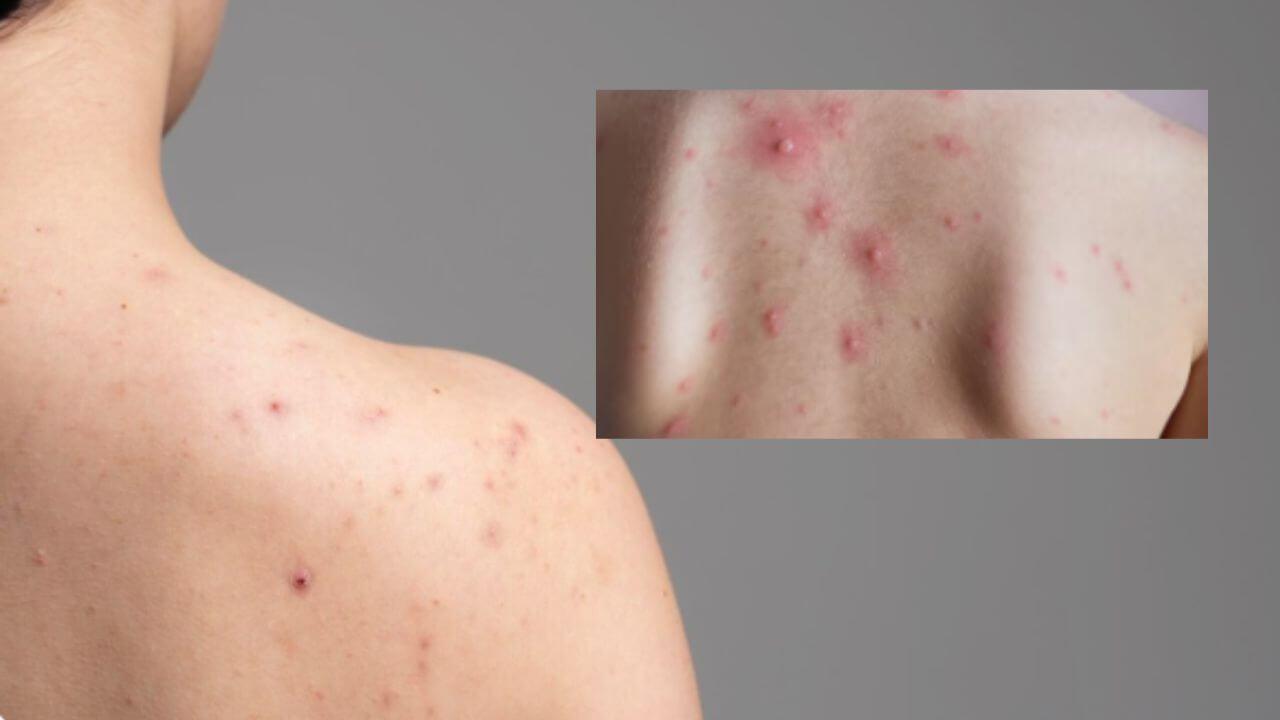 पाठीवर सतत पुरळ आणि फोड येतात? ‘हे’ घरगुती उपाय दूर करतील समस्या