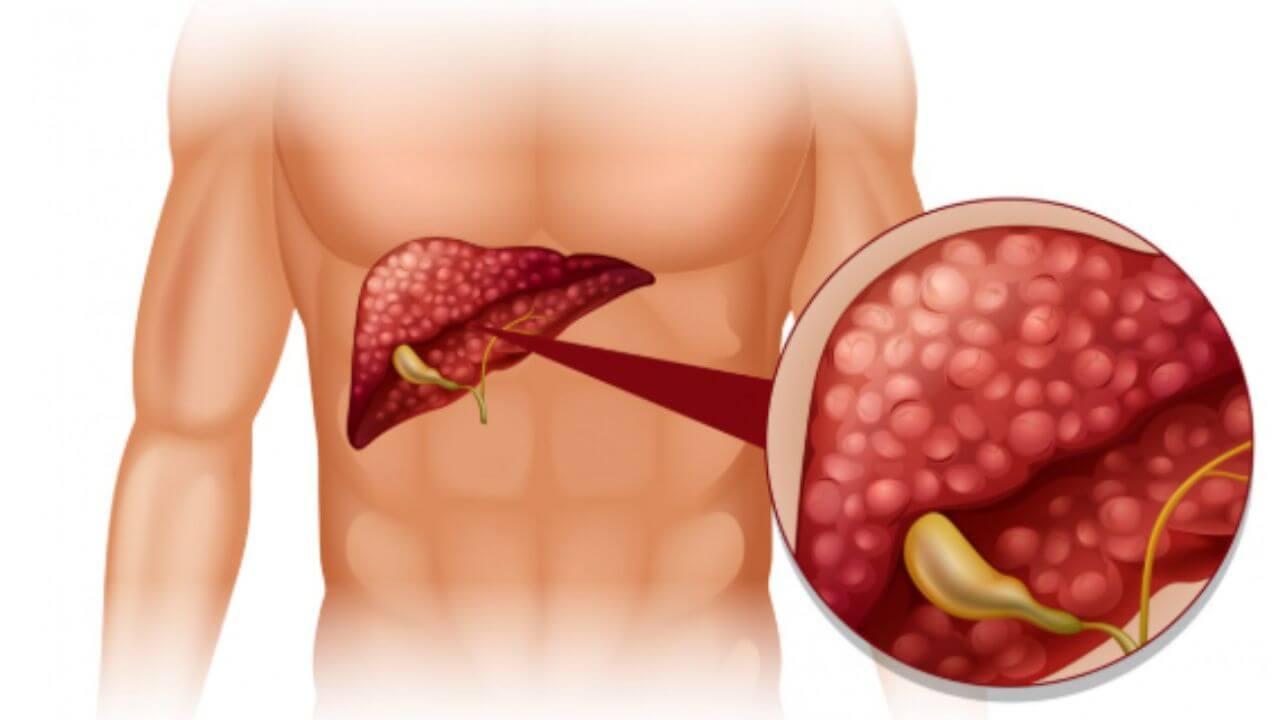 यकृत खराब झाल्यास शरीराच्या कोणत्या भागावर कोणती लक्षणे दिसतात? जाणून घ्या