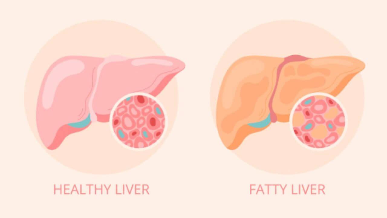 फॅटी लिव्हरची समस्या दूर करण्यासाठी स्वतःला लावा ‘या’ ४ सवयी