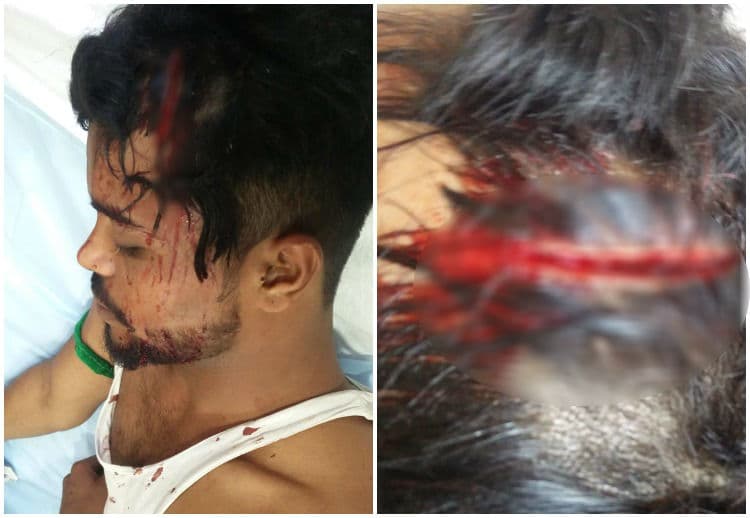 चाय पर चर्चा के दौरान युवक पर हमला, 6 इंच लंबे घाव को पुलिस बता रही मामूली झगड़ा