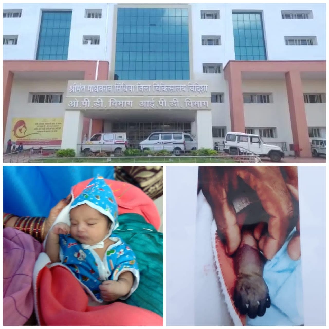 डॉक्टरों की लापरवाही से नवजात का हाथ खराब, काटना पड़ेगा हाथ