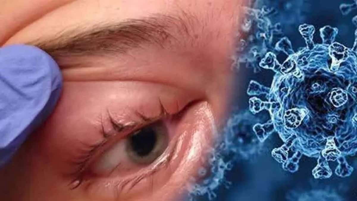 खरगोन में सामने आया ब्लैक फंगस का पहला मामला