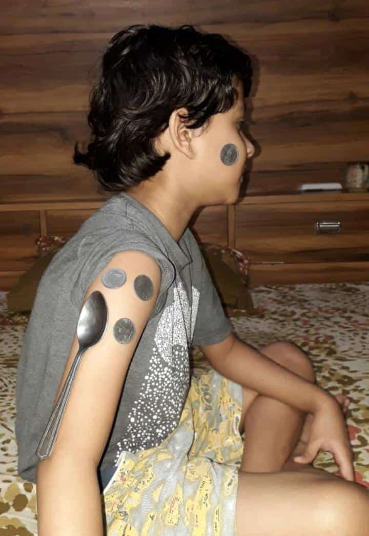 राजगढ़ में बालिका ने शरीर पर चिपकाए चम्मच व सिक्के, वैक्सीनेशन नहीं बल्कि पसीने को बताया वजह