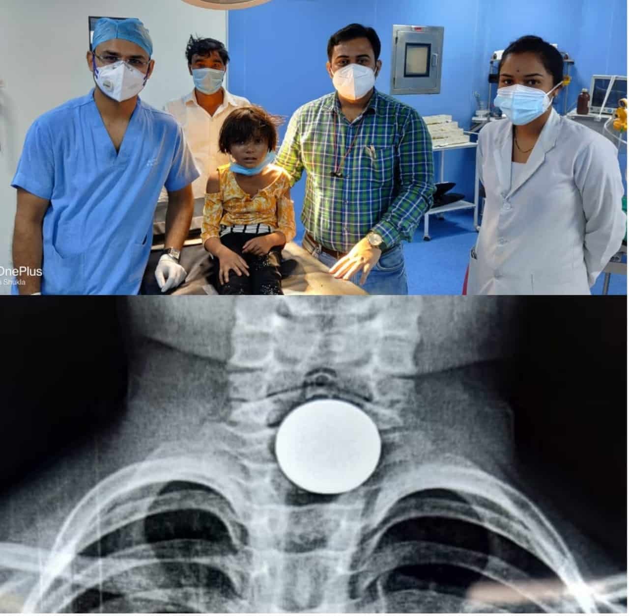 डॉक्टरों ने दिखाया चमत्कार, मासूम बच्ची के गले से बिना सर्जरी के निकाला सिक्का, परिजनों ने जताया आभार