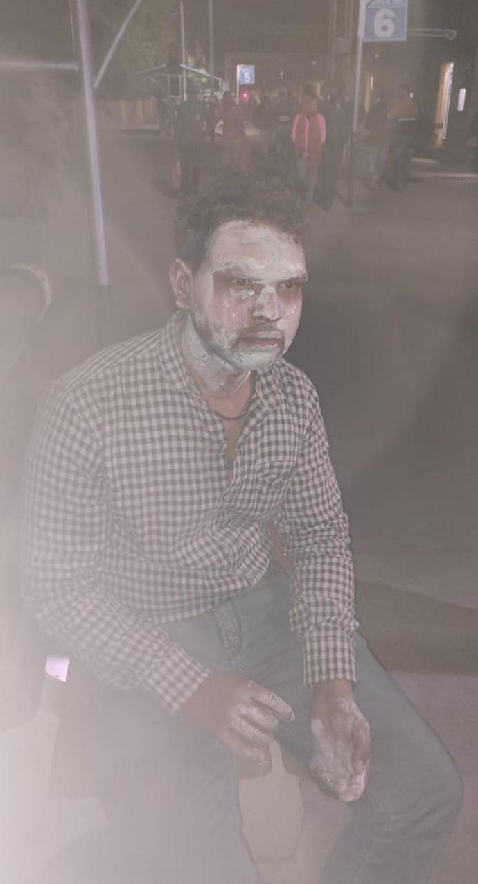 अंजान युवती ने युवक के चेहरे पर मुँह में भरा पेट्रोल छिड़क कर लाइटर से लगाई आग