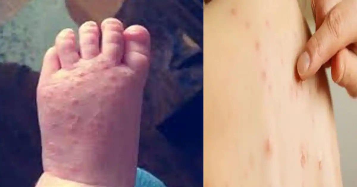 कोरोना के बाद इन 3 बीमारियों ने पूरी दुनिया में मचा रखा है तहलका