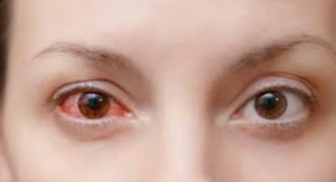 MP News : Eye Flu और Conjunctivitis से बचाव के लिए NHM ने जारी की एडवाइजरी, इस तरह रखें अपनी आंखों को सुरक्षित