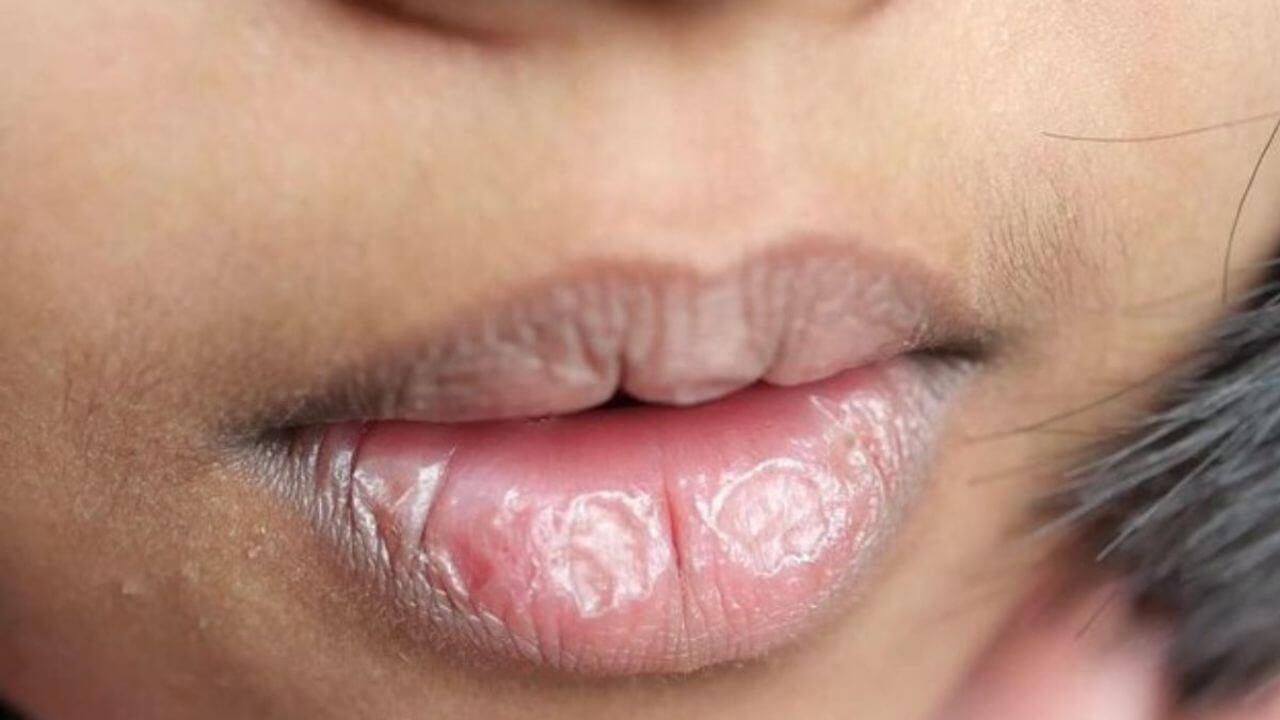 क्या हैं आपके होंठों के काले पड़ने के कारण? जानें सलाह