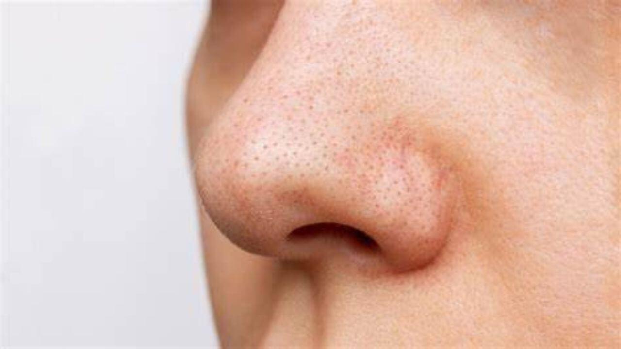 ब्लैकहेड्स की समस्या? घर पर कैसे ट्राई करें इसे हटाने के सबसे असरदार तरीके