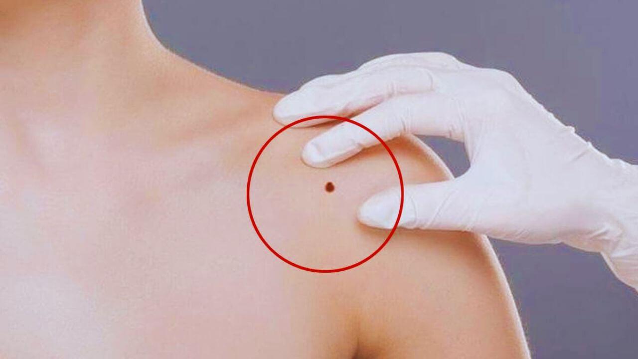 Mole Personality Test: कंधे का तिल खोलेगा व्यक्तित्व के छुपे हुए राज, पता चलेगा कैसा है स्वभाव
