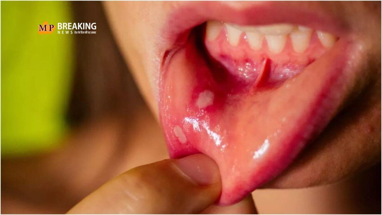 मुंह में होने वाले छालों को नहीं करना चाहिए नजरअंदाज, हो सकते हैं बीमारी का कारण!