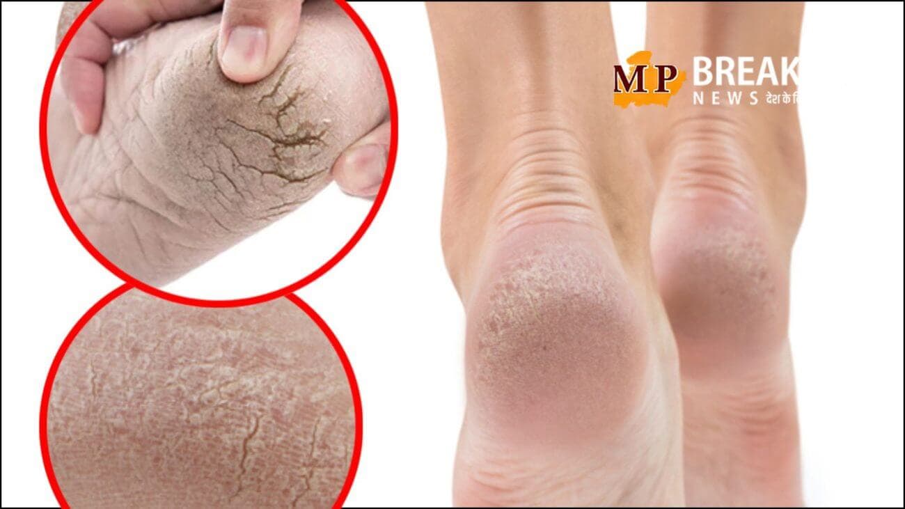 क्या आप भी एड़ी फटने की समस्या से परेशान हैं? इस देसी नुस्खे से पाएं छुटकारा
