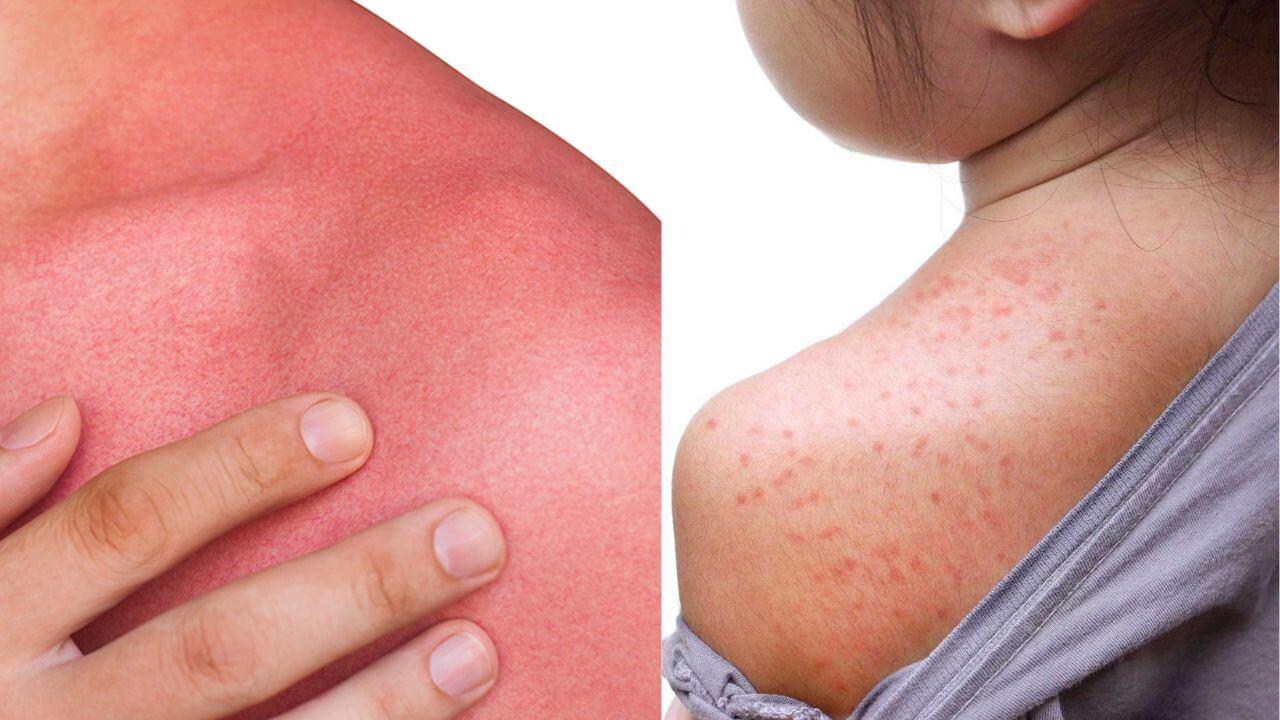 गर्मी में घमौरियों से हो गई हालत खराब? इन देसी नुस्खों से पाएं झटपट राहत