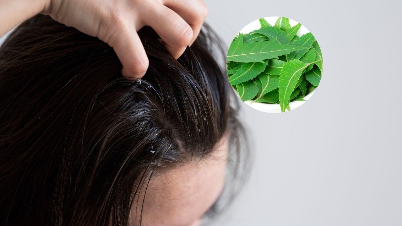 मानसून में जूं और लीख से छुटकारा पाने का घरेलू तरीका, स्कैल्प रहेगा नीम से पूरी तरह साफ