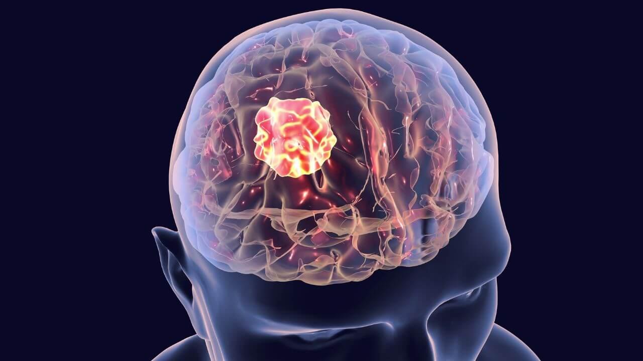 Brain Tumor की शुरुआत इन्हीं 5 आदतों से होती है, नंबर 3 कर रही है सबसे ज़्यादा नुकसान