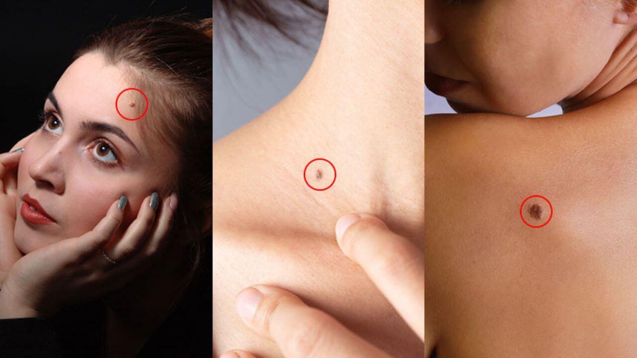 क्या आपको भी है शरीर के इन हिस्सों पर तिल? भाग्यशाली होने का है संकेत