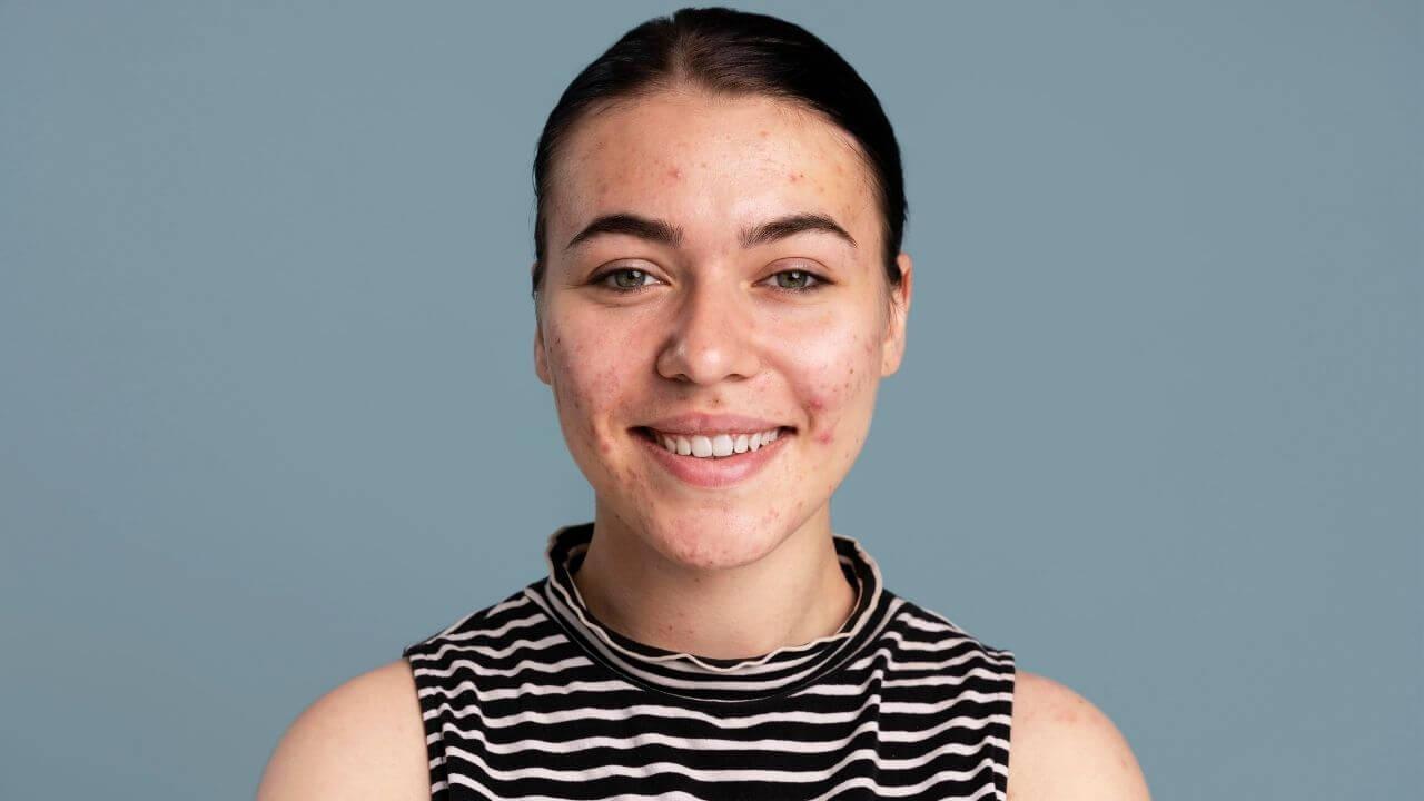 मानसून में ऑयली स्किन से परेशान? अपनाएं ये आसान टिप्स मुंहासों और चिपचिपाहट से मिलेगी राहत