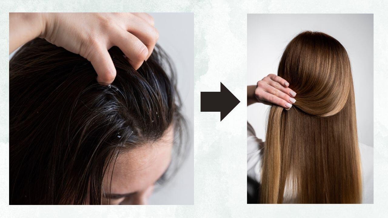 अब सिर की सफेदी नहीं बनेगी आपकी शर्मिंदगी की वजह, ये देसी इलाज देंगे परमानेंट छुटकारा