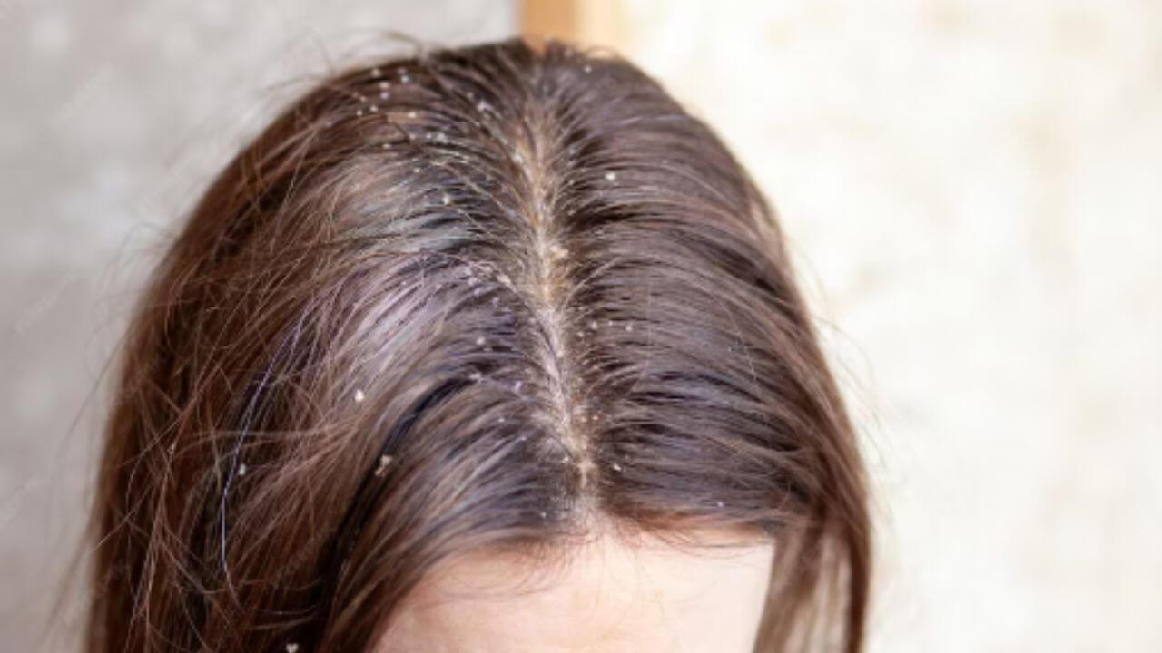 केसांमधील कोंडा कसा दूर करावा? ‘हे’ आहेत सोपे घरगुती उपाय